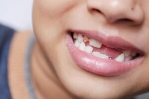 Smiling child with a missing baby tooth after a pediatric dental visit in Thornhill